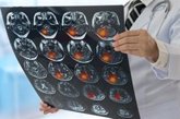 Foto: Un fármaco contra el cáncer de sangre podría aumentar la eficacia de la radioterapia en tumores cerebrales