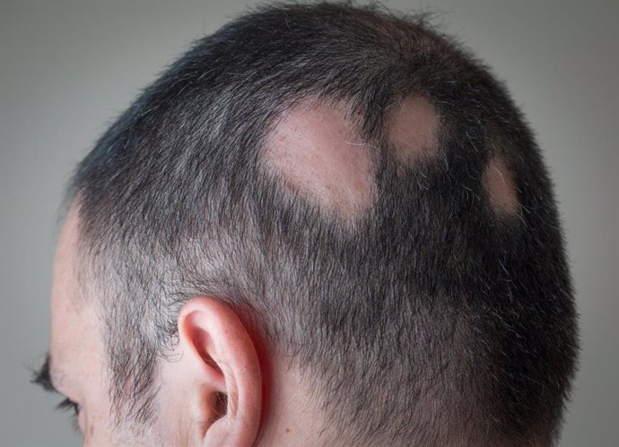 Archivo - Casi el 70% de los españoles reconoce no saber qué es la alopecia areata