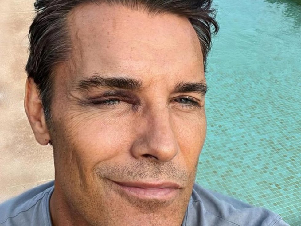 Jesús Vázquez ha publicado varias imágenes con el ojo morado durante sus vacaciones