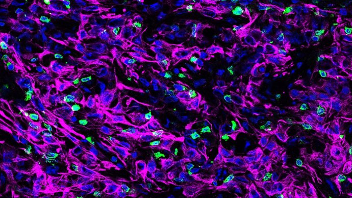 Archivo - Un corte transversal de tejido tumoral pancreático de ratón. Estas células cancerosas (teñidas de púrpura) carecen de una proteína llamada KRT19 en su capa externa que forma parte de un complejo que desactiva el movimiento de las células T (verd