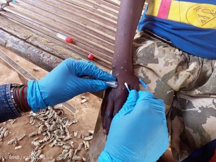 Archivo - WHO and Ministry of Health officials take a sample from an mpox patient in Mongala, Democratic Republic of the Congo, on 25 March 2023.