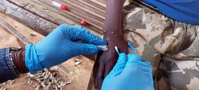 Un trabajador sanitario toma una muestra de una persona con mpox.