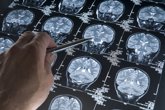 Foto: Los fármacos que mejoran el metabolismo cerebral podrían ayudar a los enfermos de Alzheimer