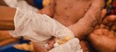 Foto: ACNUR advierte de los efectos del brote de mpox para los refugiados y las familias desplazadas en países afectados