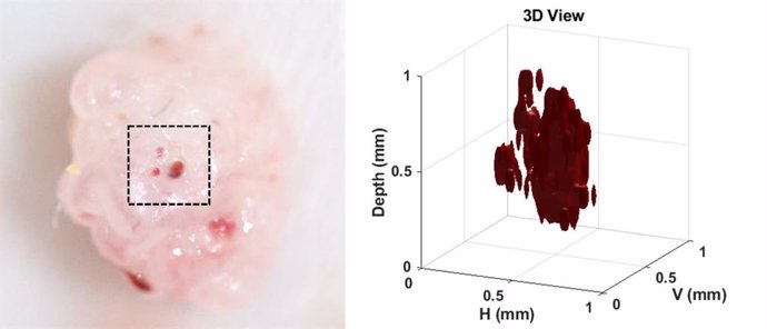 Imagen de melanoma en 3D