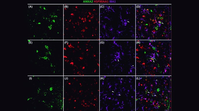 Una investigación de la UCLM que identifica tres proteínas asociadas al alzhéimer podría mejorar su diagnóstico y tratamiento