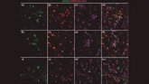 Foto: Una investigación que identifica tres proteínas asociadas al Alzheimer podría mejorar diagnóstico y tratamiento