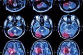 Foto: Un antidepresivo podría servir para tratar tumores cerebrales