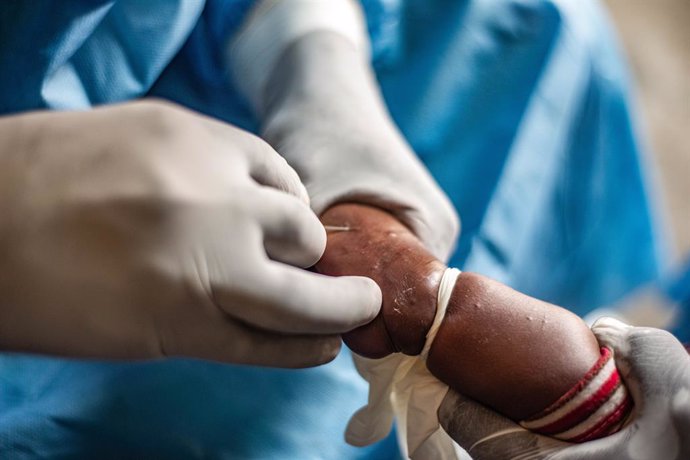 Archivo - NYIRAGONGO (DRC), Aug. 15, 2024  -- A child caught mpox gets treatment at a hospital in the Nyiragongo territory near Goma, North Kivu province, eastern Democratic Republic of the Congo (DRC), on Aug. 15, 2024. The World Health Organization (WHO