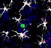 Foto: Proponen un nuevo tratamiento para la metástasis cerebral basado en la inmunoterapia