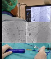 Foto: Cardiólogos resaltan las ventajas de la ablación de venas pulmonares por electroporación para fibrilación auricular