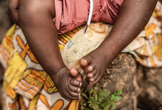 Archivo - BEIJING, Aug. 17, 2024  -- A child infected with mpox is pictured in the Nyiragongo territory near Goma, North Kivu province, Democratic Republic of the Congo (DRC), Aug. 15, 2024.   The World Health Organization (WHO) declared Wednesday mpox a 