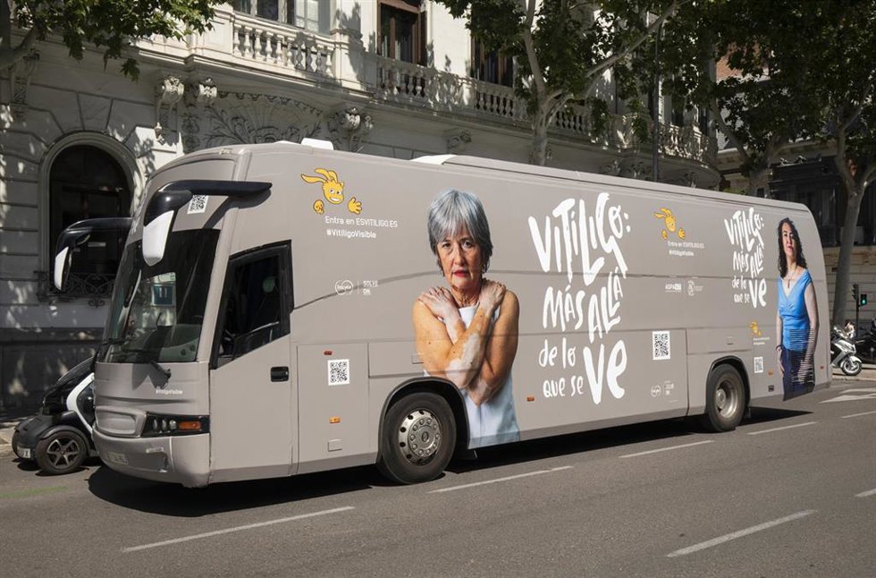Archivo - Incyte ha puesto en marcha la campaña 'Vitíligo: más allá de lo que se ve', que tiene el aval de la Asociación de Pacientes de Vitíligo (ASPAVIT) y ha sido revisada por la Fundación Piel Sana de la Asociación Española de Dermatología y Venereo