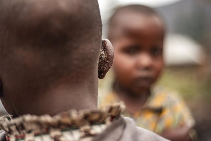 Archivo - NYIRAGONGO (DRC), Aug. 15, 2024  -- A child caught mpox is seen at a hospital in the Nyiragongo territory near Goma, North Kivu province, eastern Democratic Republic of the Congo (DRC), on Aug. 15, 2024. The World Health Organization (WHO) decla