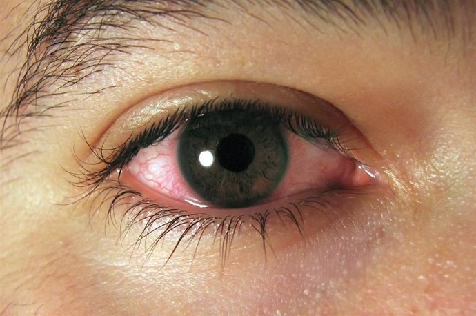 Archivo - Conjuntivitis. Ojos rojos.