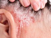 Foto: Dermatólogos aseguran que la psoriasis en el cuero cabelludo puede afectar a entre un 60% y un 80% de los pacientes