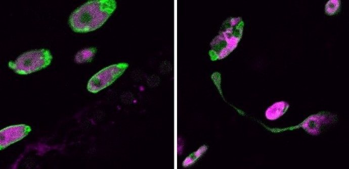 La progeria es una enfermedad rara que acelera el envejecimiento prematuro.