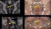 Foto: La terapia focal para el cáncer de próstata permite a más del 91% de los pacientes mantener la función urinaria y sexual