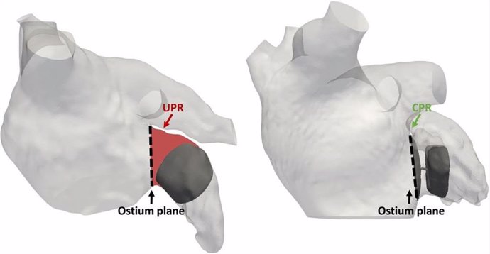 Simulaciones de la operación de fibrilación articular, realizadas por la Universitat Pompeu Fabra y el Hospital de Burdeos