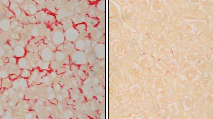 Tejido derivado del músculo con fibrosis hepático (izquierda) y después del tratamiento (derecha).