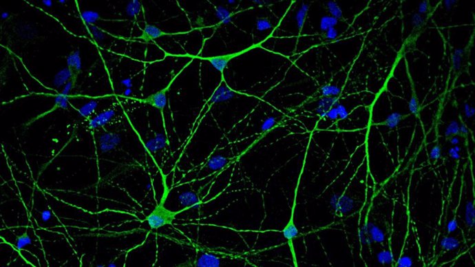 Neuronas generadas a partir de células madre de un paciente con Alzheimer.