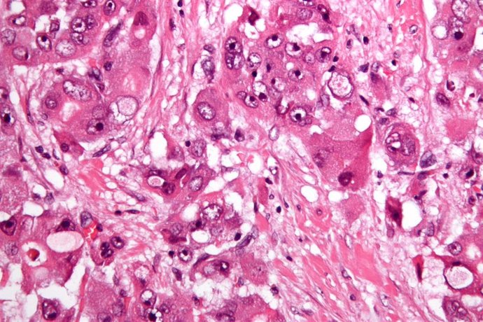 Una variante del carcinoma hepatocelular usadas en el estudio