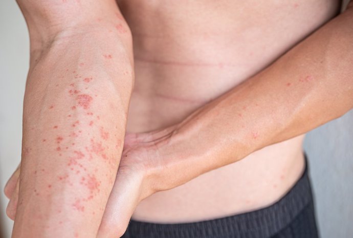 Archivo - Imagen de archivo de una persona con dermatitis atópica.