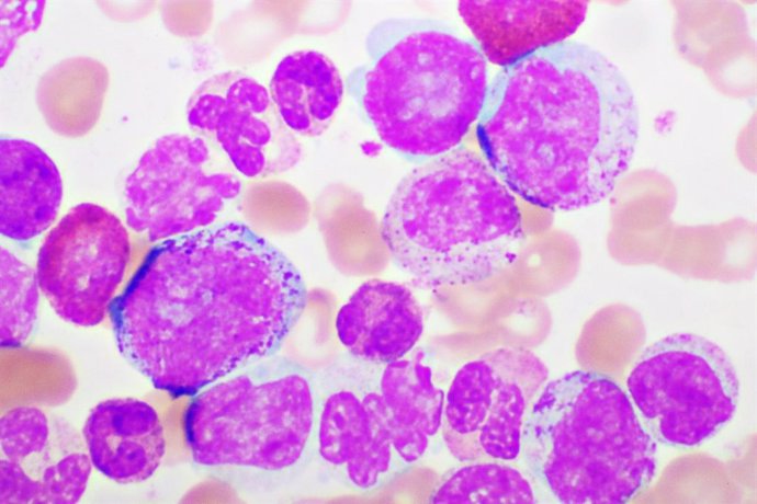 Archivo - Image de leucemia mieloide.