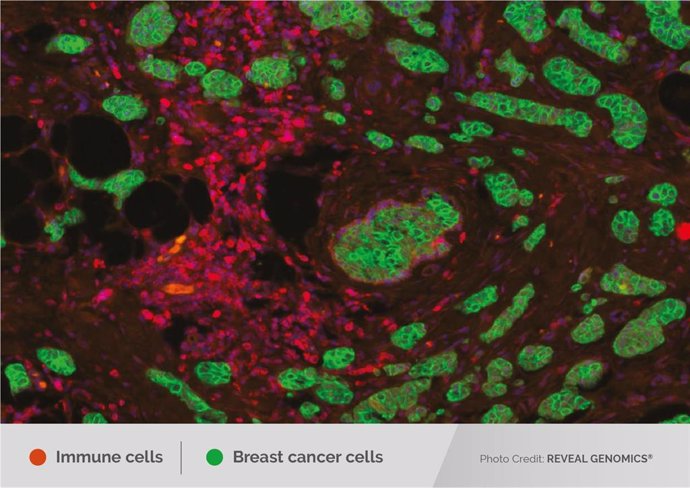 Células inmunes interaccionando con el cáncer de mama