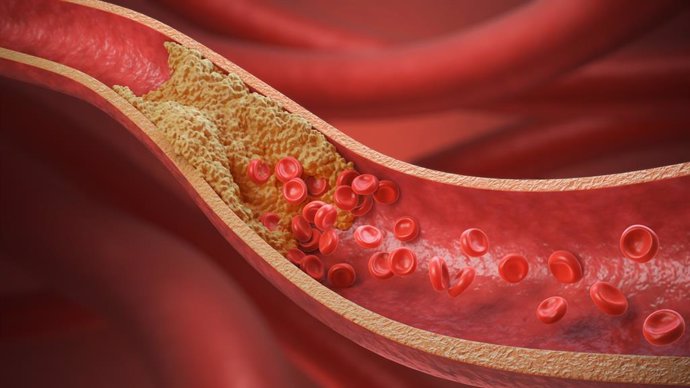 Archivo - High Blood Cholesterol, Thickened Arteries and Veins, Red Blood Cells, 3d illustration.