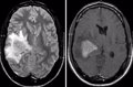 La edad es el principal factor de riesgo para padecer linfoma cerebral, según experto