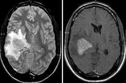 Linfoma cerebral