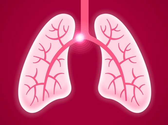 Archivo - Embolia pulmonar.