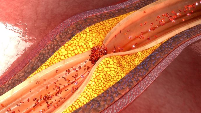 Archivo - Aterosclerosis, ateroma, arteria obstruida