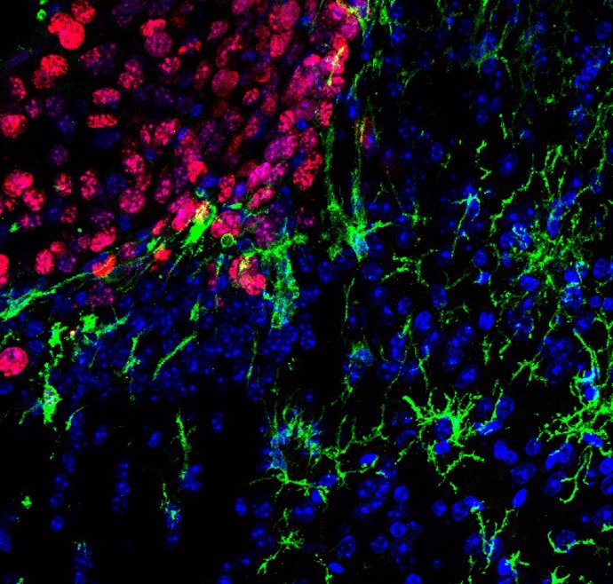 La imagen muestra las células de la microglía (en verde) infiltrándose entre las células tumorales de una metástasis de melanoma (en rojo). Los núcleos de las células están marcados en azul.