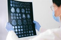 No todas las epilepsias conllevan convulsiones: por qué se producen y cómo tratarlas