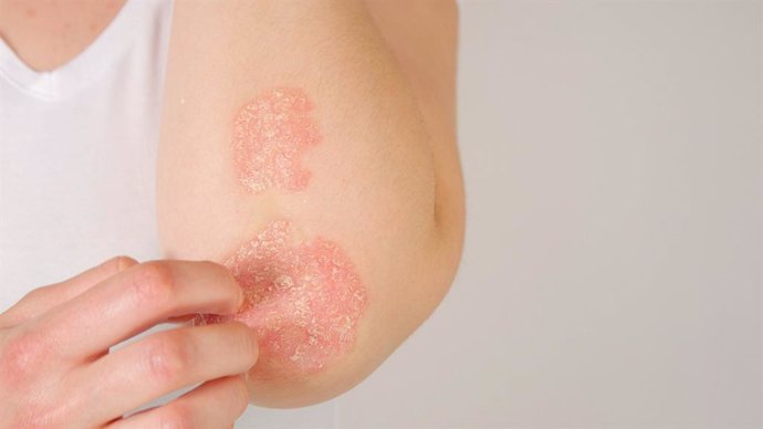 Archivo - CLOSE UP: Unrecognizable young woman suffering from autoimmune incurable dermatological skin disease called psoriasis. Female gently scratching red, inflamed, scaly rash on elbows. Psoriatic arthritis