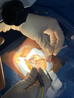 El Hospital Clínico de València incorpora una nueva técnica láser para intervenciones de glaucoma