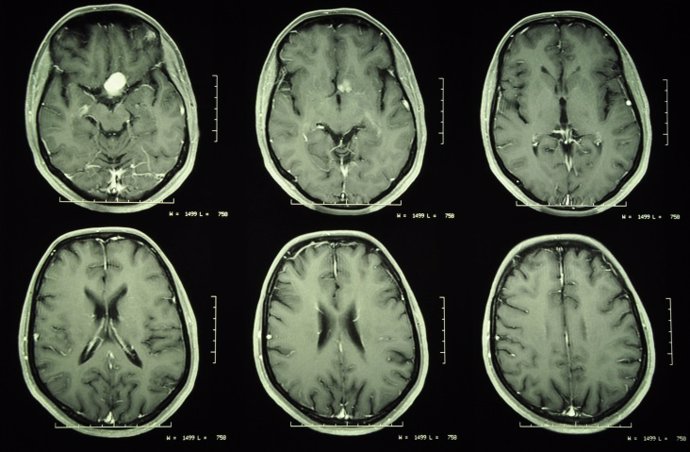 Archivo - MR of a benign brain tumor (meningeoma)