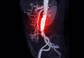 Foto: La inhibición de la enzima 'ACLY', la técnica que podría frenar el empeoramiento del aneurisma de aorta abdominal