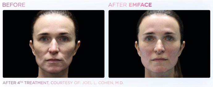 Before and after EMFACE: After 4th treatment, courtesy of: Joel L. Cohen, M.D.