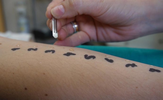 Prueba de alergias en el Hospital Virgen Macarena.