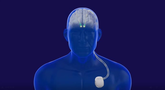 Sistema de estimulação cerebral profunda semelhante a um marcapasso para pacientes com Parkinson