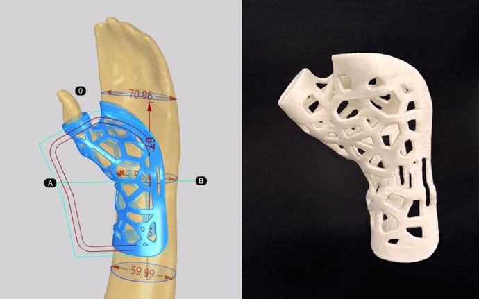 Implantes y ortesis de IBV