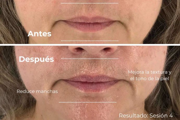 Lifting 4D, novedad mundial en rejuvenecimiento perdurable sin inyecciones