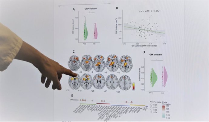 Investigadores españoles revelan nuevos cambios cerebrales y alteraciones cognitivas en Covid persistente