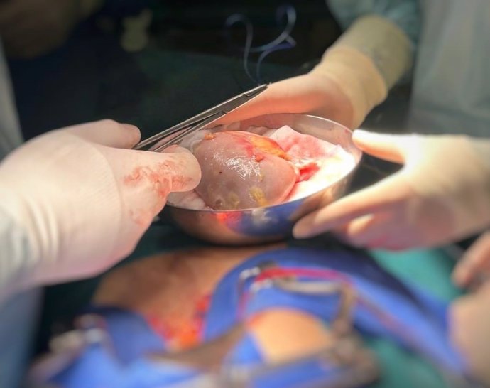 El programa de trasplante renal de pacientes hiperinmunizados en Andalucía encuentra un riñón compatible para 417 personas.