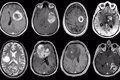 ¿Nuevo tratamiento para el glioblastoma? Un biomarcador podría mejorar la inmunoterapia