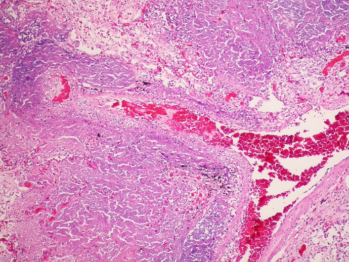 Archivo - Arquivo - Tuberculose