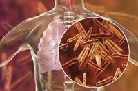 La SEPAR advierte de que la incidencia de tuberculosis ha aumentado un 7% en España